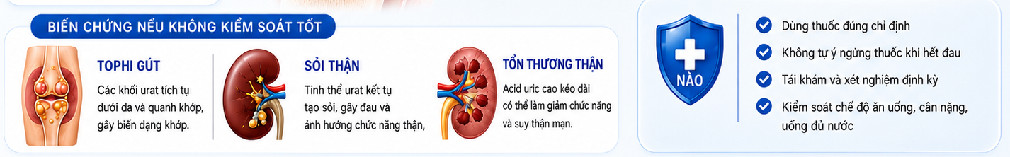 Biến chứng gút nếu không kiểm soát tốt: tophi gút, sỏi thận, tổn thương thận